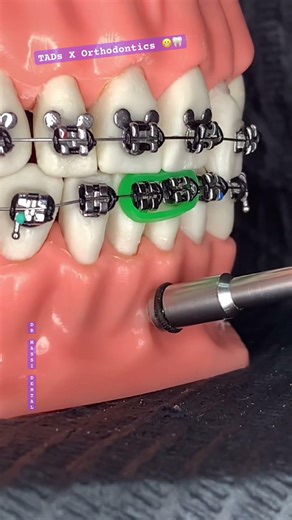 TADs Orthodontics 😬🦷