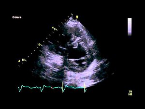 Left Atrial and Ventricular Thrombus - Transthoracic Echocardiogram (TTE)