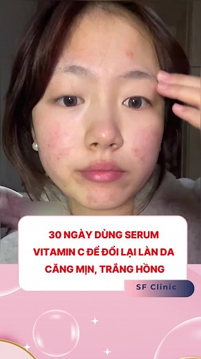 30 ngày dùng serum vitamin C để đổi lại da trắng hồng #vitaminc #tip #xh #via #sfclinic