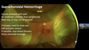 Trabeculectomy Complications
