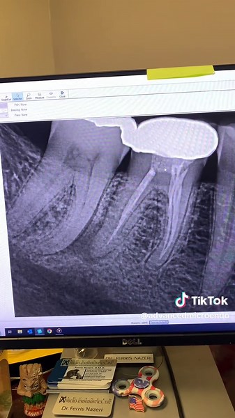 Endodontic Retreatment of Tooth #30 Explained