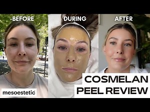 COSMELAN DEPIGMENTATION PEEL | chemical peel for pigmentation + dark spots