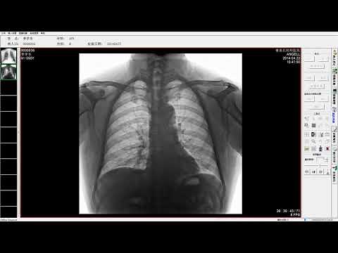 DT570 Chest Fluoroscopy
