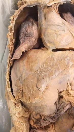 Why do we get hiccups? 🤔🤷‍♀️ Find out the answer and join the discussion! #hiccups #curiosity #nowyouknow For more on Hiccups👇 https://bit.ly/3pKn77P | Institute of Human Anatomy