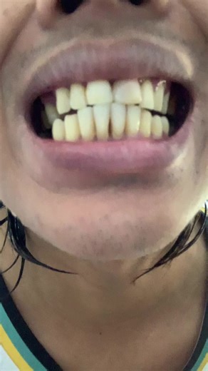 Version 5 Whitening Toothpaste Buy 1 Take 2 Offer