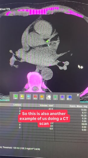 Shady Habboush on Instagram: "This is what calcified coronary arteries look like on a CT coronary angiogram. Calcium inside the coronary arteries is abnormal and reflects atherosclerotic plaque burden, increasing future cardiovascular risk. White spots on a CT coronary angiogram = coronary calcium. A sign of atherosclerosis and an early warning of coronary artery disease. Coronary arteries should be soft and dark on CT. When they appear white, it means calcification — a marker of coronary artery