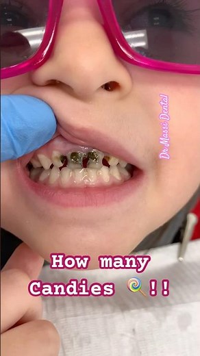 How many Cavities? How many Candies 🍭!!