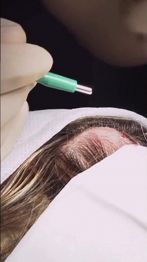 Regenera Activa for Hair Loss | Dr. Medispa