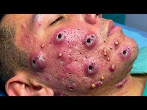 You Won't Believe What Came Out Of These Pimples