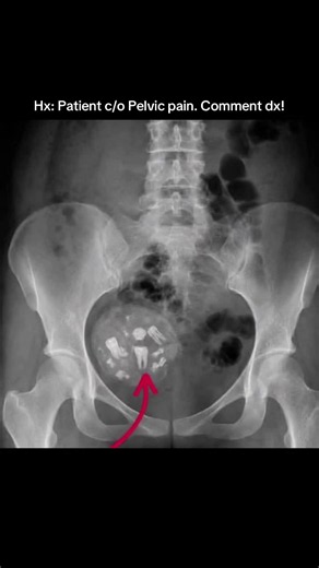 Comment diagnosis!? #radschoolbro #xray #xraystudent #radiology #xraytech
