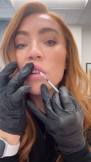 Jamie Davis RN,BSN on Instagram: "Damn, sorry guys. But beauty is pain, amiright? Don’t worry we have ways to make this process super comfortable! ** disclosure I don’t actually inject myself! No lips were harmed in the making of this reel 💋 #juvederm #utah #arlani #allergan #slc"