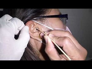 Dry Sheet of Earwax Removed from Woman's Ear | Or Is It A Skin?