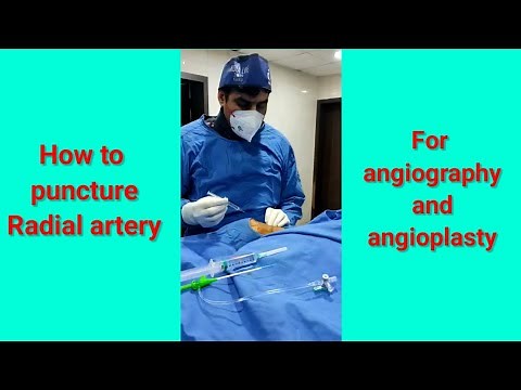 Radial artery puncture technique, radial puncture