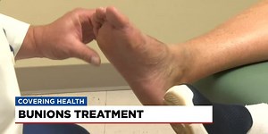 Surgery known as Lapiplasty helps address bunions at the root cause
