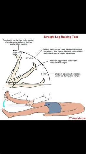 Saeed Ahmad on Instagram: "✅ The straight leg raise (SLR) test is a physical examination maneuver used to identify nerve root irritation or compression in the lower back, commonly associated with conditions like a herniated disc. ✅ During the test, a healthcare provider lifts a patient's leg while they lie on their back, keeping the knee straight. A positive result is indicated when the test reproduces pain down the leg, typically in the sciatic nerve distribution, often between 30 and 70 degree