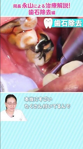 院長永山による治療解説！ 歯石除去編 #dentist #歯医者 #歯石