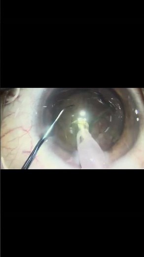 Vertical Phaco Chop - How to do it? #cataractsurgerymentor #drdianelesleywebster