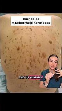 Skin Barnacles” Explained (Seborrheic Keratoses)