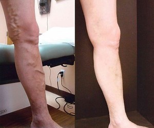 Understanding Venous Disease; What you need to know and why