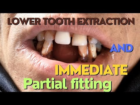 Lower front tooth extraction + urgent replacement | tooth extraction | missing tooth replacement