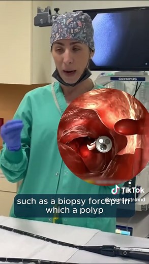 🔬 Many people are curious about what a colonoscopy room looks like and what equipment is used during the procedure. In this video, I show the endoscopy room where colonoscopies are performed and explain the main tools we use to examine the colon. 🩺 The most important instrument is the colonoscope, a long and flexible tube that allows doctors to see the inside of the colon. Even though it may look large at first, it’s actually quite thin. 🔧 If a polyp is found growing on the wall of the colon,