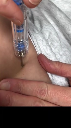 Zoladex Injection