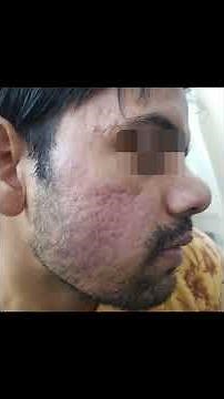Laser acne scar removal || Before and after results || Laser treatment for scars
