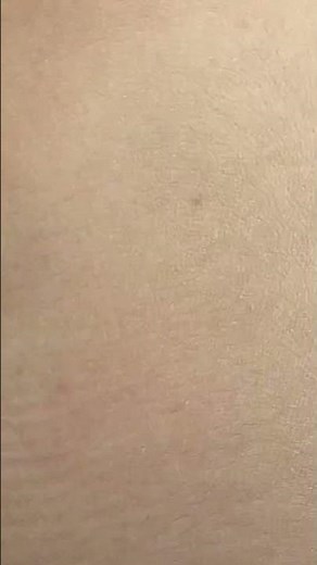 this is my back acne - by teacher Huong #điềutrịmụn #acnetreatment #maingoc #acne #acnetherapy
