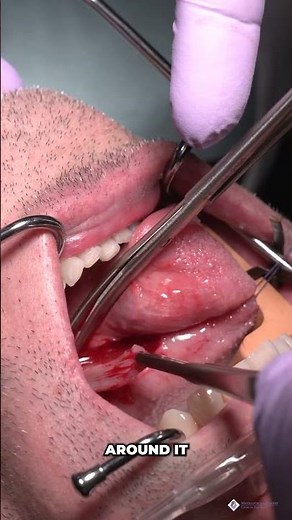 Oral Biopsies: Why They Matter