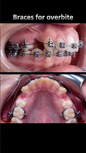 Braces for buck teeth (extraction required) #braces #orthodontist #orthodontics #dentist #teeth
