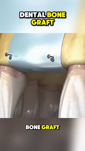 2.1K views · 16 reactions | #surgery #3d #3danimation | Surgery Page | Facebook