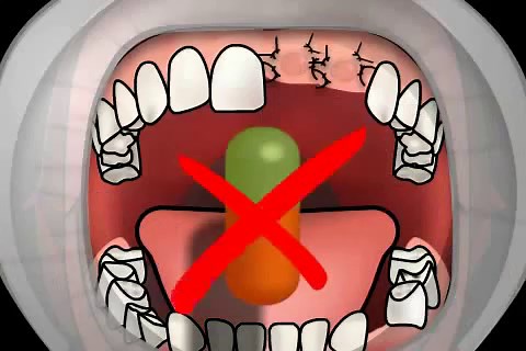 Zahnextraktion: Was man nach dem Zahn Ziehen beachten muss