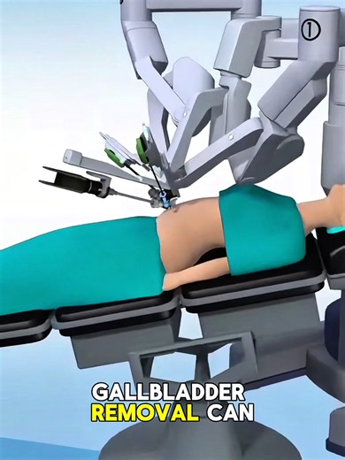 How Gallbladder Removal Surgery Safely Ends Gallstone Pain for Good(3D Animation) #cholecystectomy #gallbladdersurgery #gallstones #medicalprocedure #healtheducation