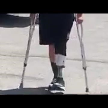 Left Leg Below Knee Amputee walking with crutches | amputee on stairs