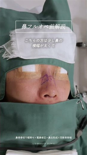 鼻オペ前の解説💡#鼻整形 #解説 #shorts