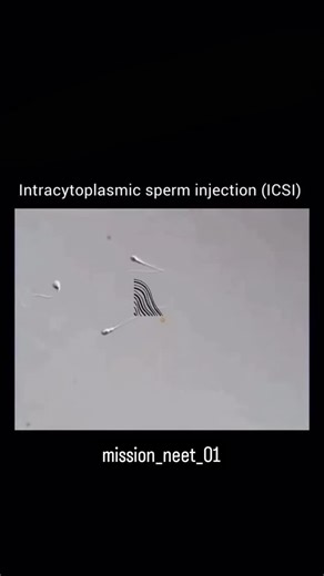 DR on Instagram: "Intracytoplasmic Sperm Injection (ICSI) ICSI is an advanced technique used in in vitro fertilization (IVF) where a single sperm is directly injected into the egg to achieve fertilization. It is most commonly used in cases of male infertility. #science #ivf#doctorlife #treding #viral"
