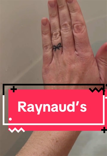 Raynauds - Look at the color differences in my arm, hand, and fingers #raynauds #sle #lupus #autoimmunedisease #lupuswarrior
