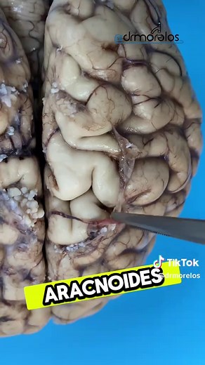 Meninges; las capas que protegen el cerebro #drmorelos #cerebro