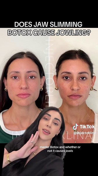 Does jaw slimming botox cause jowling? Let’s break it down because when it’s done right, not is it only beautiful, but it’s life changing for patients that suffer from TMJ related pain and headaches! #masseterbotox #jawslimming #tmjtreatment #tmjdisorder #injectorlina