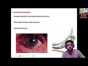 Everything one needs to know about Entropion