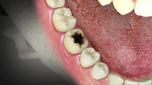 3d Root Canal Treatment Visual Stock Footage Video (100% Royalty-free) 1106140983 | Shutterstock