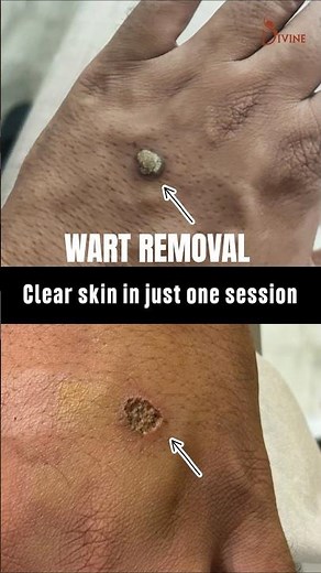 Wart Removal Before & After | Safe, Painless & Quick Treatment