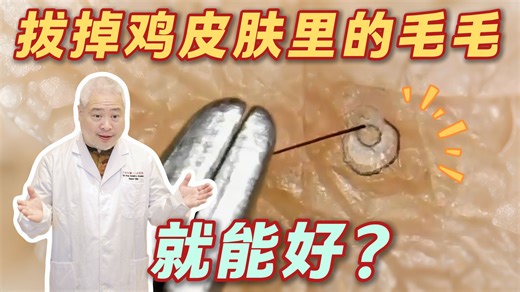 【科普】抠鸡皮肤里被堵住的毛毛，简直是强迫症福音……