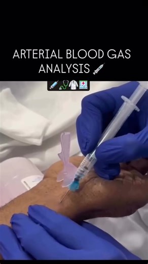 arterial blood gas analysis (abg)#medico #aiims #shortvideo #sample #blood