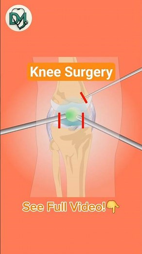 Knee Ligament Surgery 3D Animation | ACL Reconstruction & Arthroscopy Explained