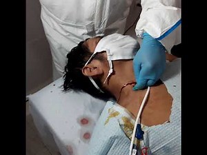 Colocación de un catéter permacath, permanente , parte 2