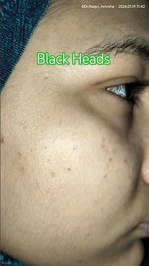 Black Heads, pimples and Acne #blackheads #pimple #acne #drnaqviamroha