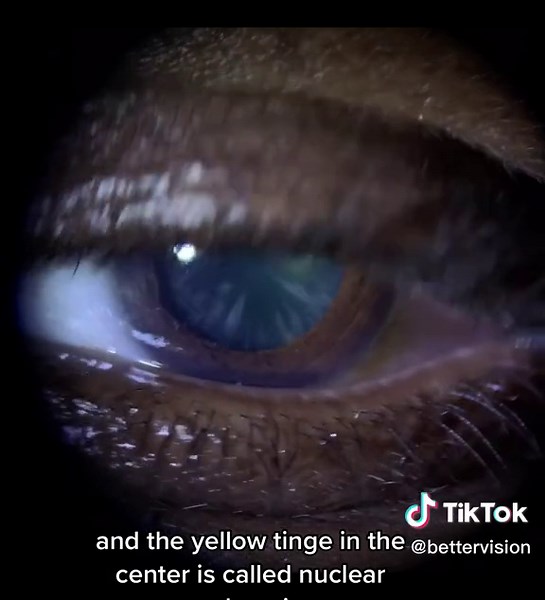 Understanding Cataracts: Types and Symptoms Explained