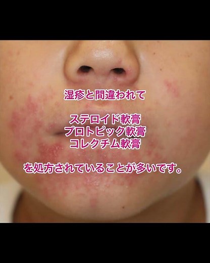 口の周りのぶつぶつが治らない。口囲皮膚炎ではないですか？