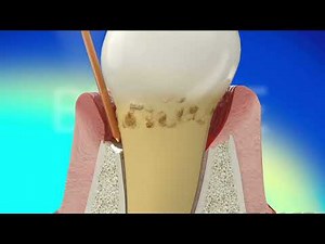 LANAP Laser Gum Therapy Procedure explained